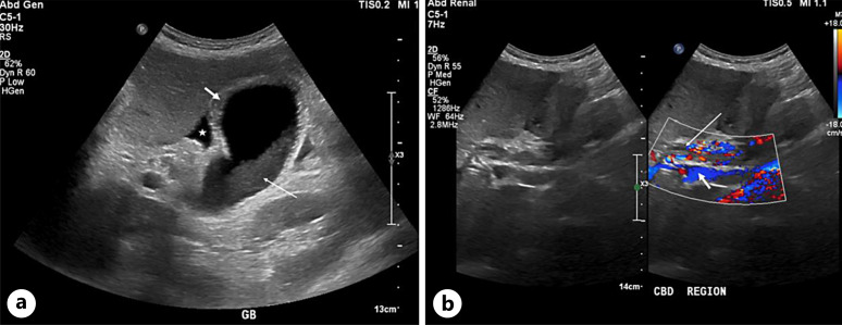 COVID-19 Induced Cholangiopathy: A Case Report.