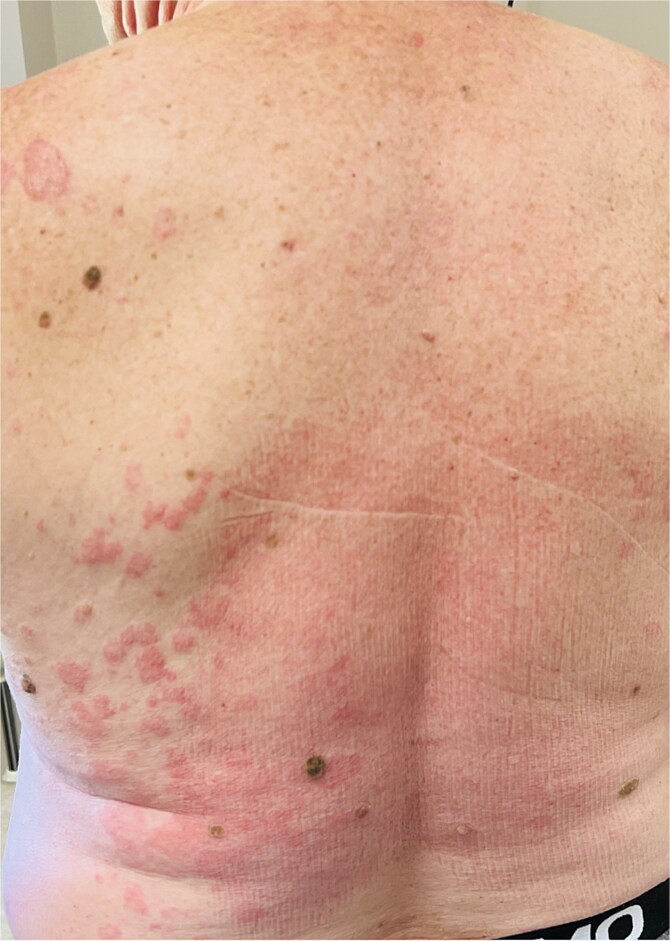 Schnitzler syndrome - a rare cause of chronic urticaria. Case report.