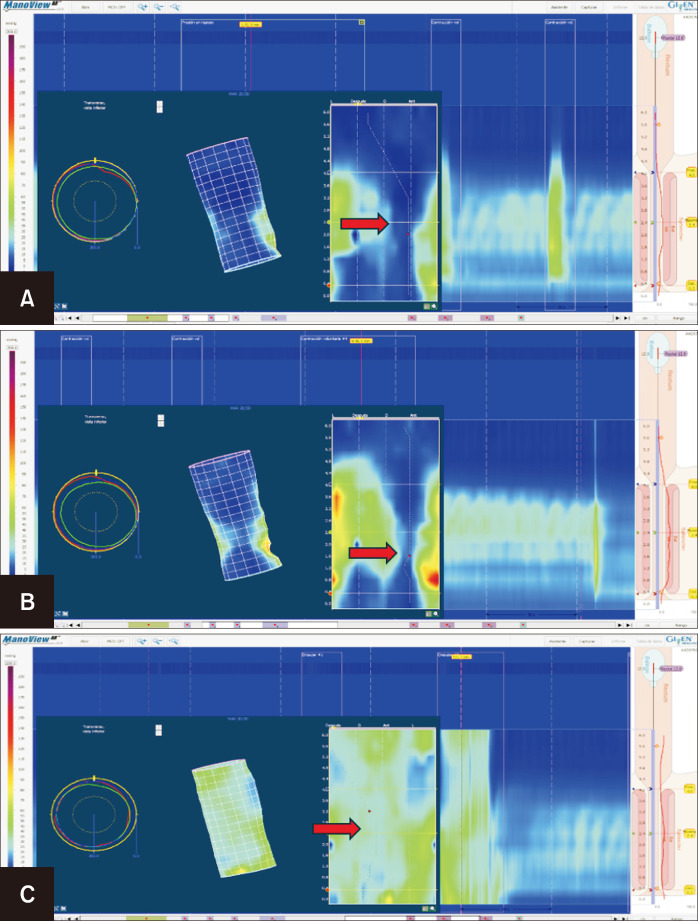 The Value of 3-Dimensional Anorectal Manometry in the Evaluation of Obstetric Anal Sphincter Injuries.