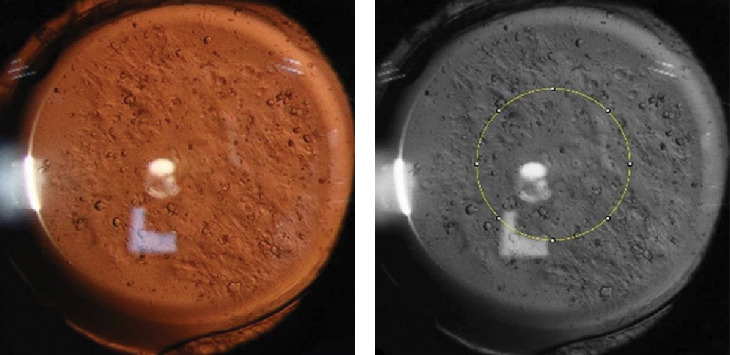 Study of Visual Quality and Higher Order Aberrations in Early Posterior Capsular Opacification.