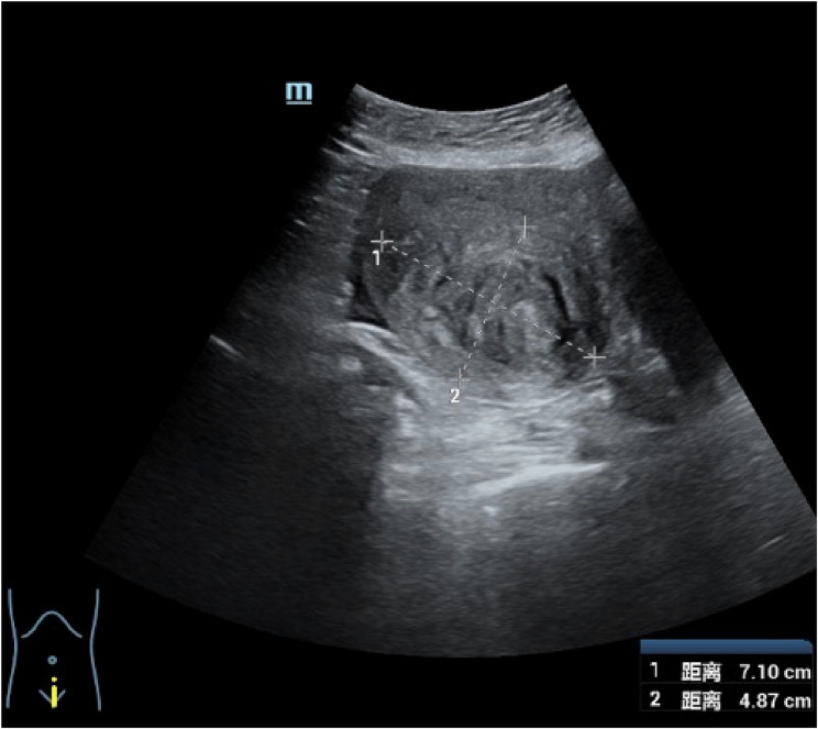 Ureteral endometriosis post-hysterectomy for adenomyosis: a case report and literature review.