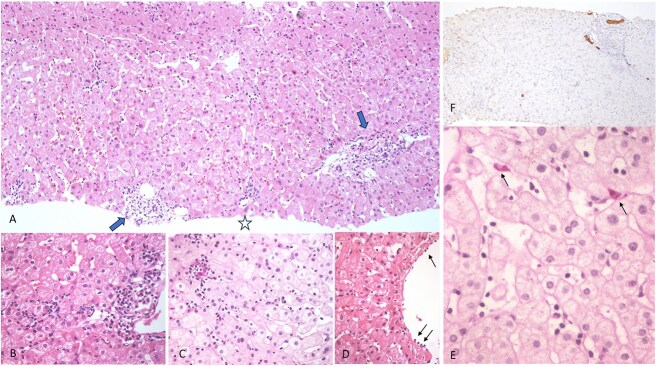 Drug-induced liver injury secondary to rituximab use.