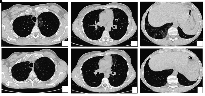 The dark side of pulmonary alveolar proteinosis.