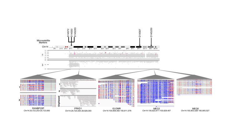 Using long-read sequencing to detect and subtype a case with Temple syndrome.