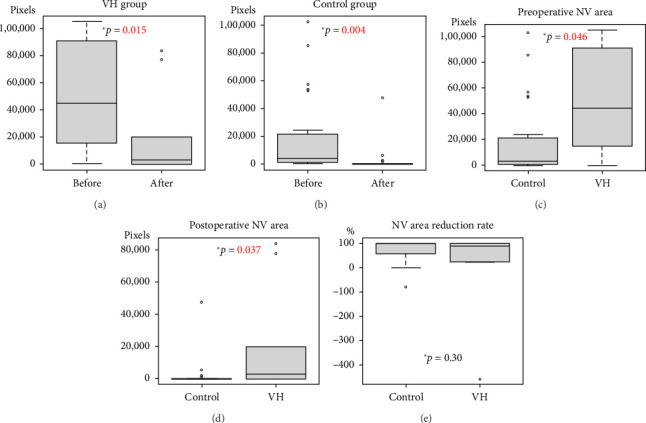 Correlation Between Postoperative Vitreous Hemorrhage and Preoperative Evaluation of Optical Coherence Tomography Angiography in Proliferative Diabetic Retinopathy Surgery.
