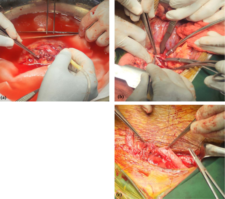 Renal Autotransplantation for Complete Ureteral Avulsion Following Dilation and Curettage: A Rare Iatrogenic Complication.