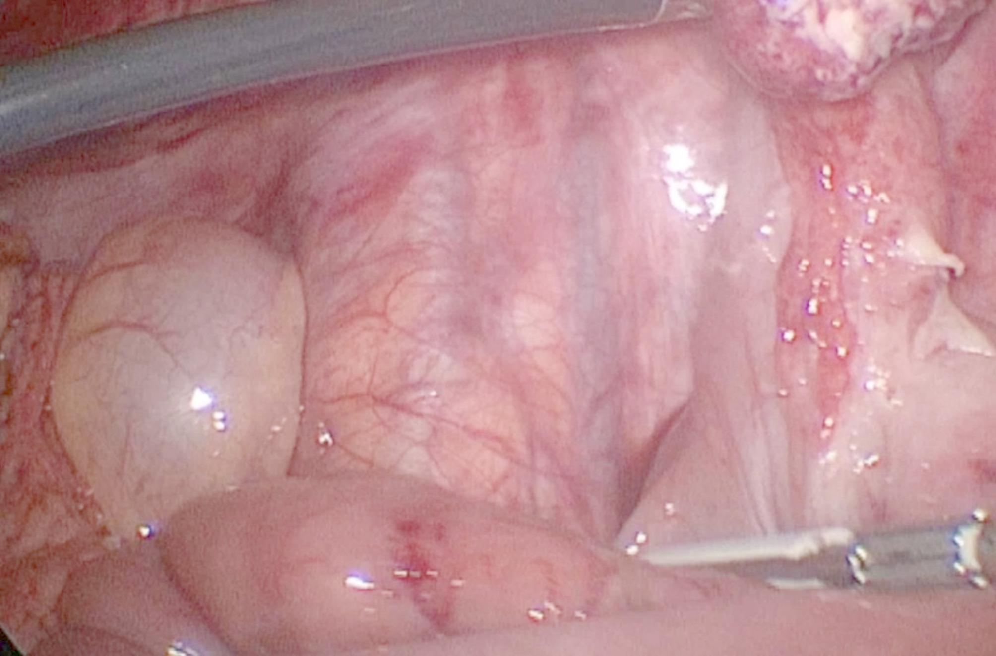 Perforated meckel's diverticulum misdiagnosed as a urinary tract infection in an 11-year-old adolescent: case report of a rare differential diagnosis.