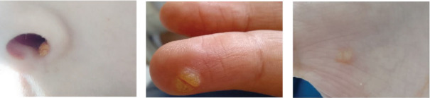 Major Histocompatibility Complex Class II Deficiency Beyond Infancy.