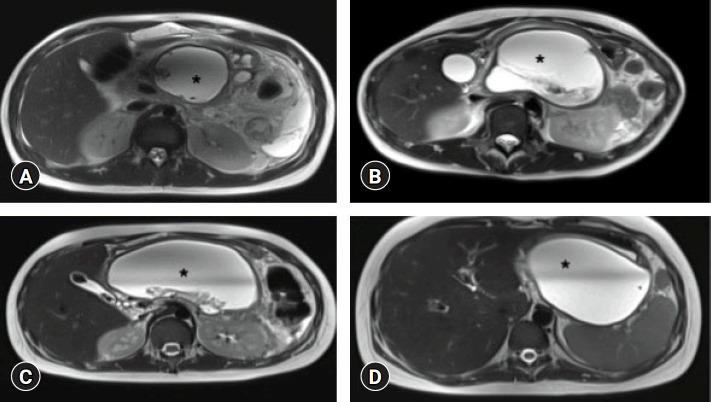 Exploring lumen-apposing metal stents as a novel approach for managing walled-off necrosis in pediatric acute pancreatitis in Indian cohort: a prospective study.