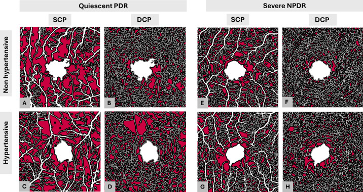 The Impact of Hypertension on Macular Perfusion in Patients With Referable Diabetic Retinopathy: An OCTA Analysis.