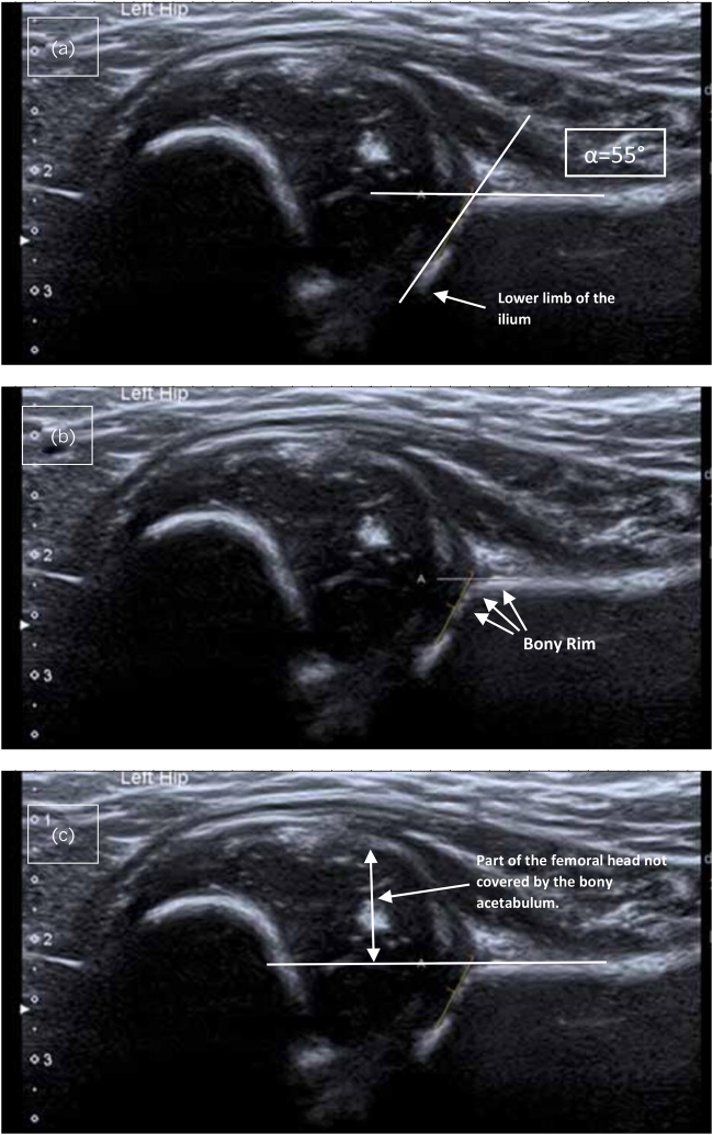 Dislocation of the hip after normal sonographic screening examination: a case report and literature review.