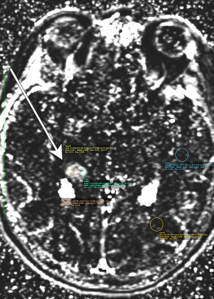 Dynamic Contrast-enhanced MRI Processing Comparison for Distinguishing True Progression From Pseudoprogression in High-grade Glioma.