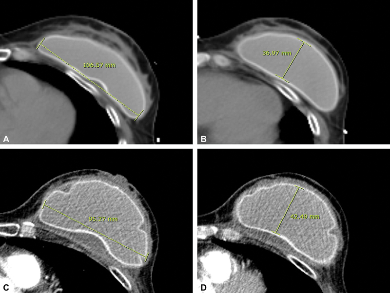 Assessment of Capsular Contracture Based on Morphological Change of Breast Implant Using Computed Tomography.