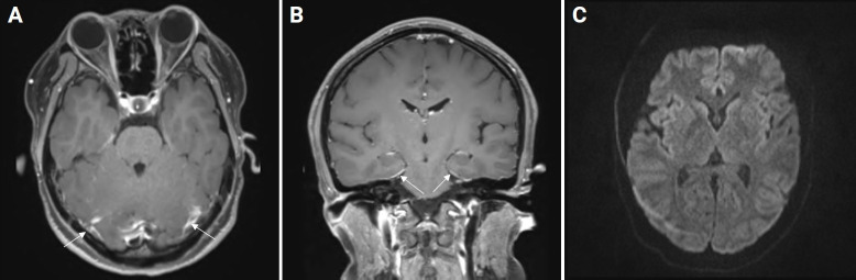 Tuberculous meningitis initially presented with low levels of pleocytosis and protein in the cerebrospinal fluid: a case report.