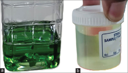 Green urine following a single induction dose of propofol.