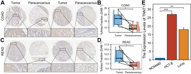 Epigenetic regulation of TNNT1 in gastrointestinal cancers prognostic implications and clinical significance.