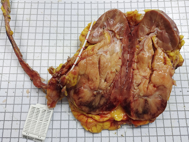 Primary renal mucosa-associated lymphoid tissue lymphoma coexisting with immune thrombocytopenia.