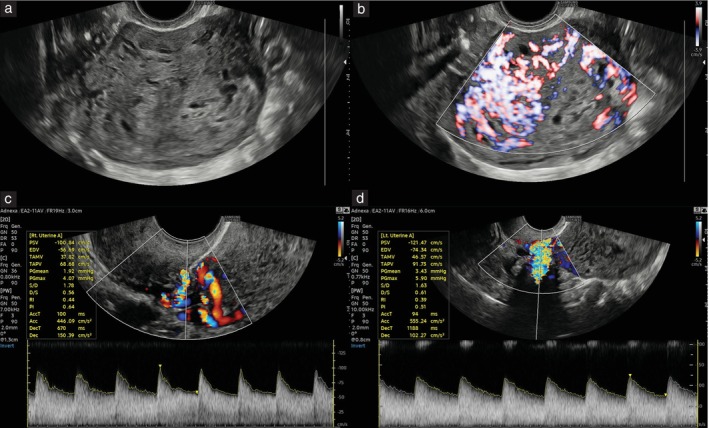 Additional value of uterine artery Doppler pulsatility index for ultrasound diagnosis of placental site trophoblastic tumor: prospective cohort study.