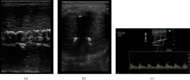 Erectile Dysfunction and Peyronie's Disease Following a Severe Case of COVID-19: A Case Report.