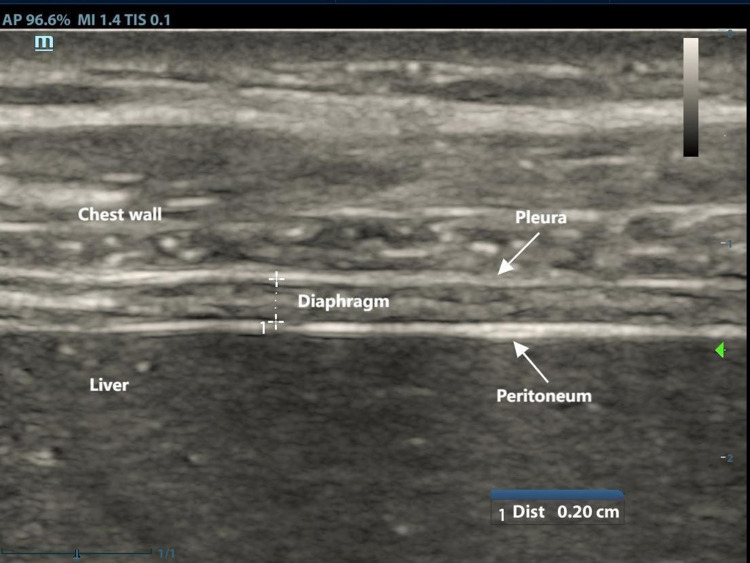 Diaphragm Assessment by Multimodal Ultrasound Imaging in Patients with Chronic Obstructive Pulmonary Disease: A Prospective Observational Study.
