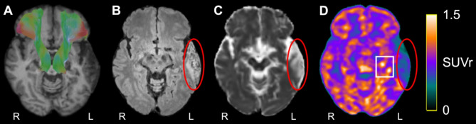 Association of white matter injury and neuroinflammation in the post-acute phase after ischemic stroke using [<sup>18</sup>F]FEPPA-PET/MRI.