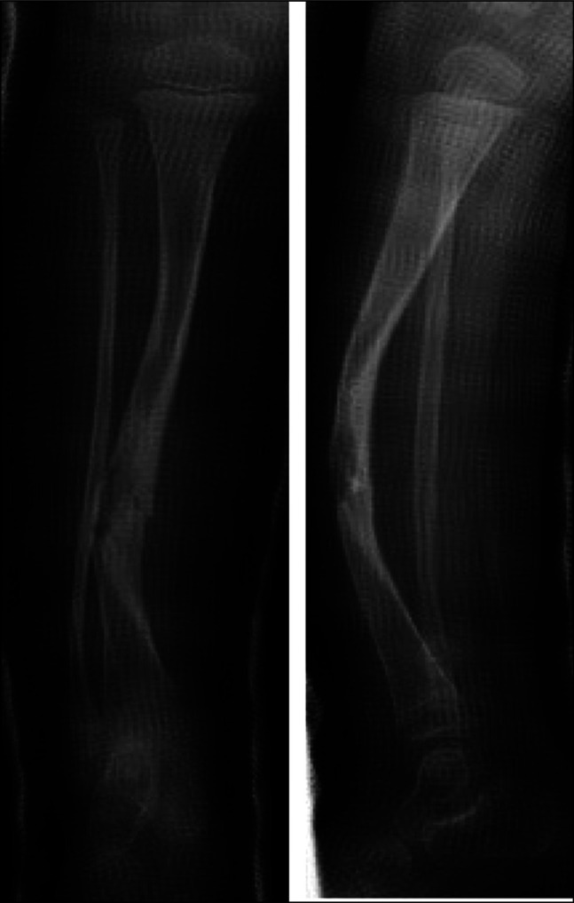 Coincidence of Congenital Pseudarthrosis of the Tibia and Hemihypertrophy in a Patient With Neurofibromatosis Type 1.