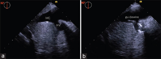 Guidewire Misplacement into the Hepatic Vein During Inferior Vena Cava Cannulation via the Femoral Vein: The Role of Transesophageal Echocardiography.