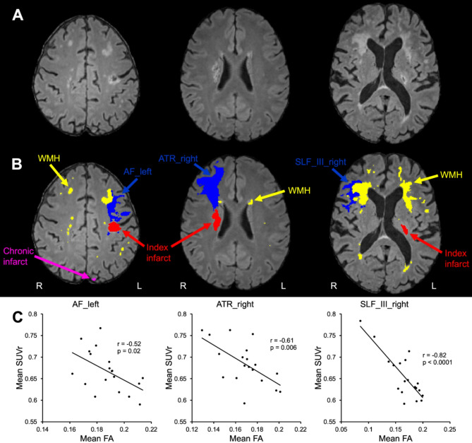 Association of white matter injury and neuroinflammation in the post-acute phase after ischemic stroke using [<sup>18</sup>F]FEPPA-PET/MRI.