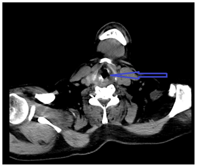 Deep Neck Space Infection as a Complication of Transesophageal Echocardiogram for Atrial Flutter Ablation.