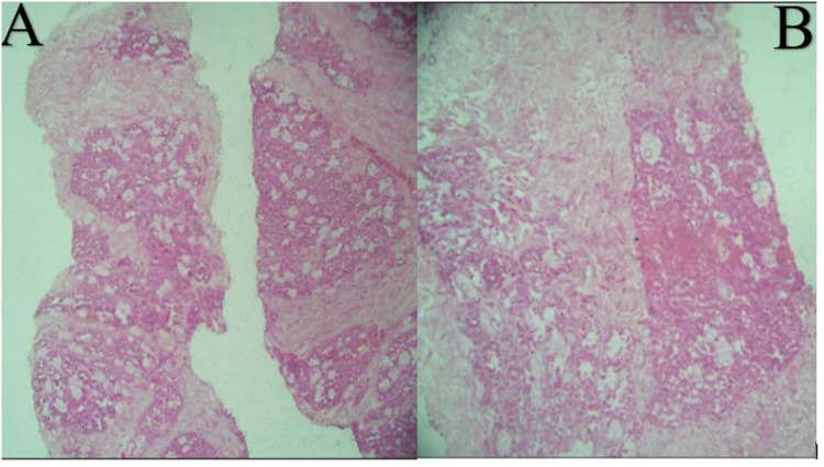 Giant Infarcted Lactating Adenoma Mimicking Inflammatory Breast Carcinoma: A First Case Report from Somalia.