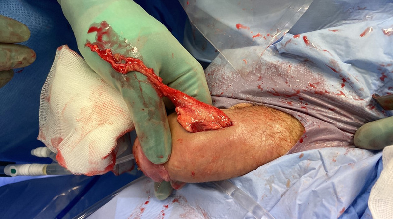 Cavernosal abscess after routine urological surgery.