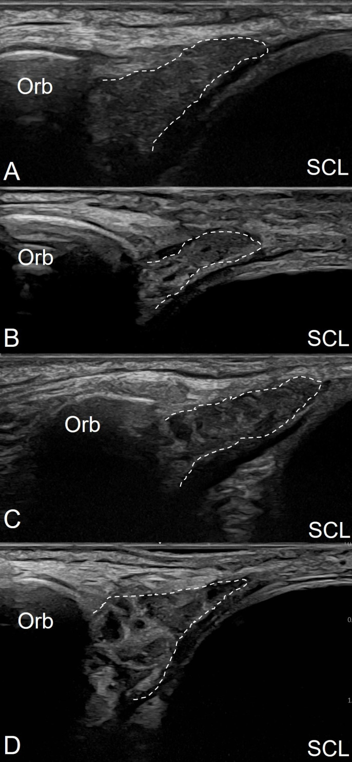 Diagnostic value of high-frequency ultrasound assessment of the lacrimal glands for primary Sjögren's disease.