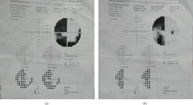 Neuro-Ophthalmic Manifestation Associated With COVID-19 in a Tertiary Eye Center in Nepal.