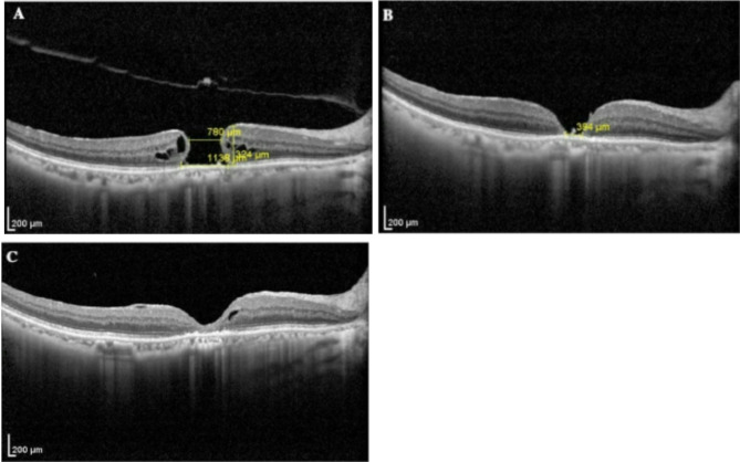 Modified two-needle technique of air/fluid exchange for in-office treatment of unhealed macular hole.