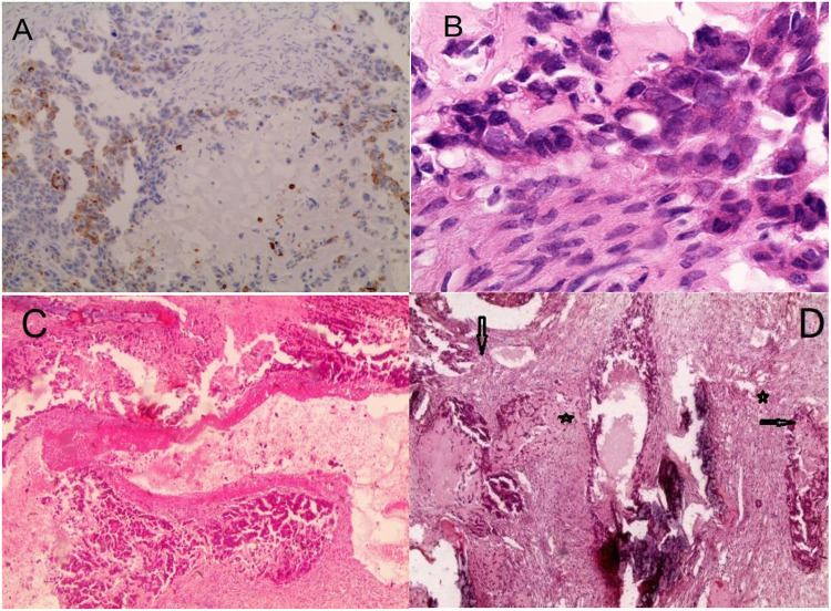 Metastatic Adamantinoma of Fibula to the Lungs: A Rare Case Report.