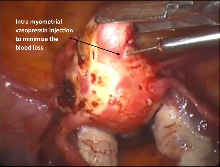 Hymen-Sparing Myomectomy: Innovative Laparoscopic Approach for Prolapsed Pedunculated Cervicovaginal Leiomyoma in a Virgin Case.