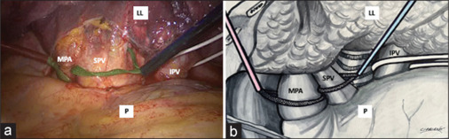 Prevention of intraoperative bleeding during thoracoscopic left lower lobectomy; an unnecessary occlusion of pulmonary artery and vein.