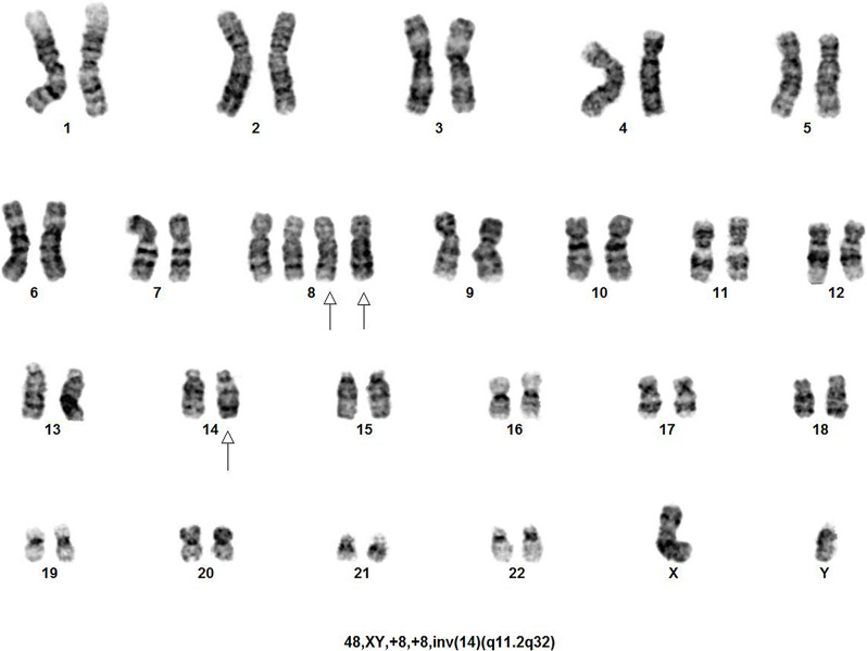 Cytogenetic finding of simultaneous inversion of chromosome 14 and tetrasomy 8 in a Pediatric B-Lymphoblastic Leukemia-a case report.