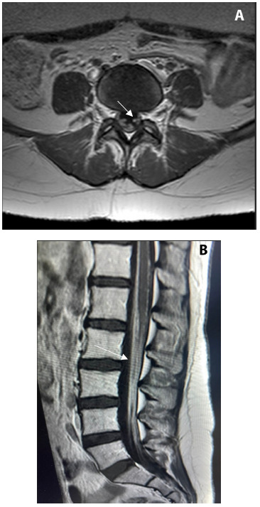 Uncommon presentation of neurobrucellosis.