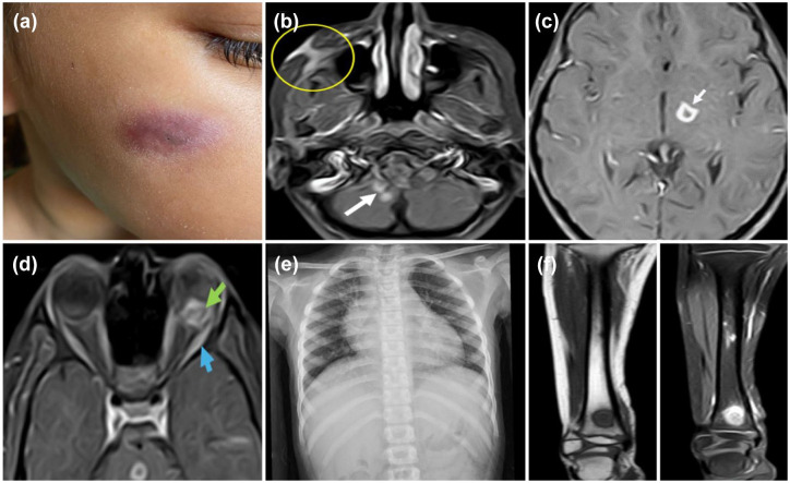 Bilateral intraocular masses in a child as a first presentation of disseminated tuberculosis: case report.