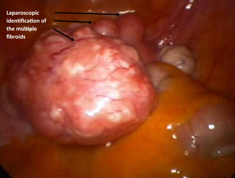 Hymen-Sparing Myomectomy: Innovative Laparoscopic Approach for Prolapsed Pedunculated Cervicovaginal Leiomyoma in a Virgin Case.