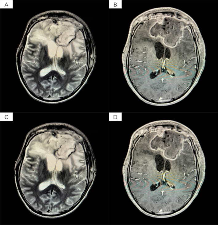 Continuous Irrigation for Refractory Multidrug-Resistant Brain Abscess in two Patients.