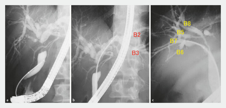 Utility of a novel tapered-tip sheath system for preoperative mapping biopsy of biliary tract cancers.