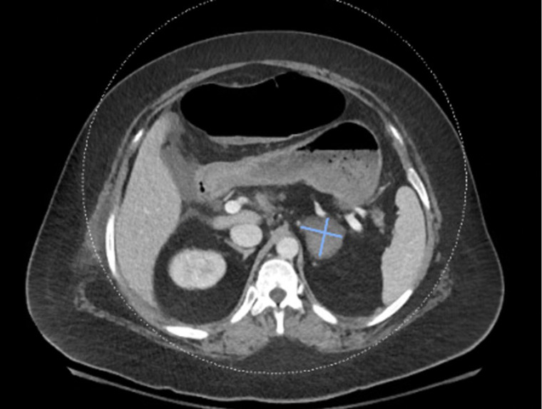 Thrombotic storm with antiphospholipid syndrome in the setting of relapsing Evans syndrome and systemic lupus erythematosus: a case report.