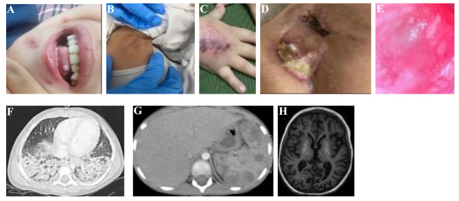 Consanguinity and rare monogenic systemic autoinflammatory disorders: implications for prevalence and genetic variability.
