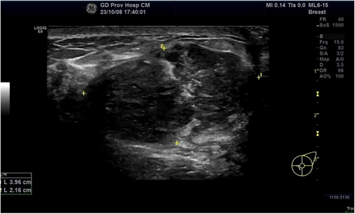 Extra-skeletal Ewing's sarcoma with EWSR1::ERG translocation of the breast: a case report.