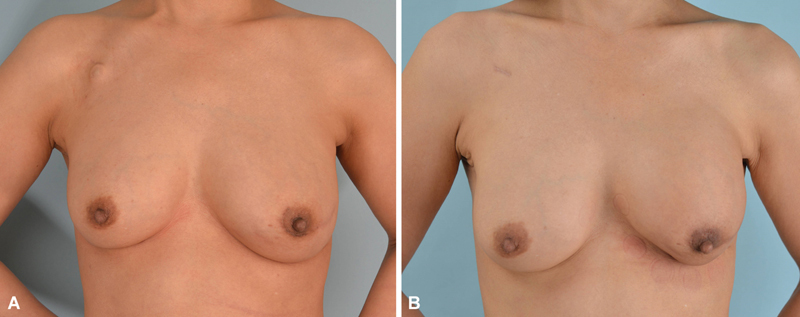 Assessment of Capsular Contracture Based on Morphological Change of Breast Implant Using Computed Tomography.
