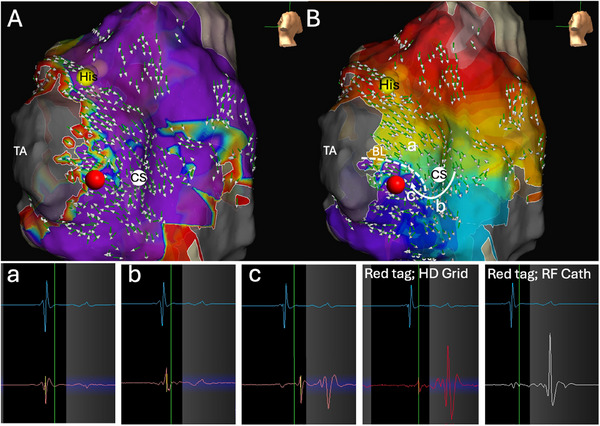 Voltage-Gradient Mapping-Guided Slow Pathway Ablation in Typical Atrioventricular Nodal Re-Entrant Tachycardia.