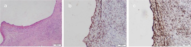 Ureteral endometriosis post-hysterectomy for adenomyosis: a case report and literature review.