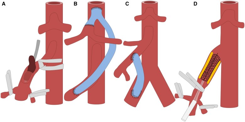Tricky acute mesenteric ischemia: what can we do?